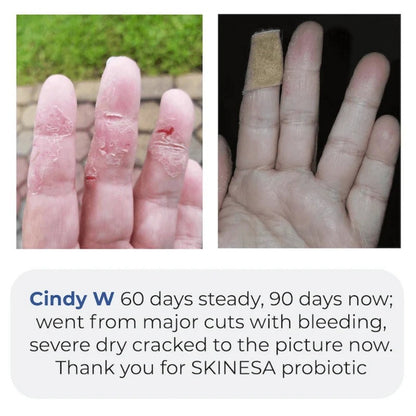Skinesa® Skin Probiotic